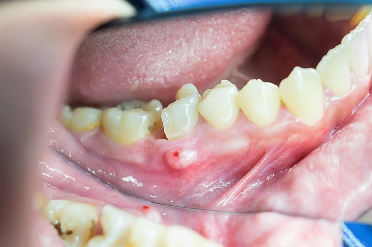 "Infection in baby tooth": Treatment Possibilities: | Dr.Imneet