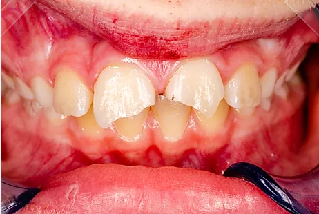 Dental Trauma Restorations Patient Before and Afters - McOmie Family  Dentistry